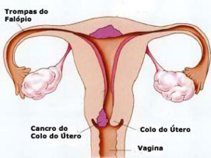 Lançada vacina contra o cancro do útero